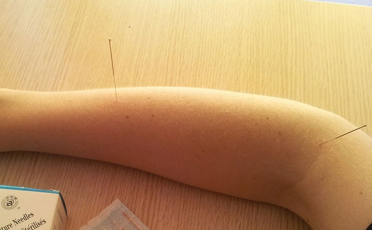 acupuncture phantom limbs