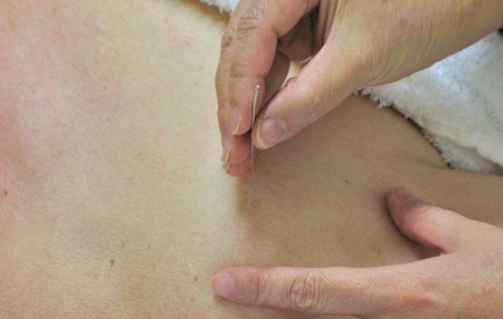 Acupuncture Southend-on-Sea, Essex