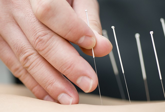 Acupuncture